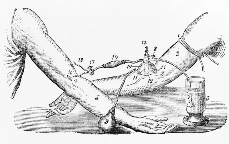 An illustration of a blood transfusion between two people in the late 19th century.