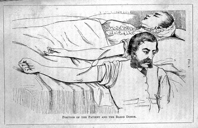 An illustration of the position of a patient and blood donor during a blood transfusion, showcasing early human-to-human transfusion techniques.