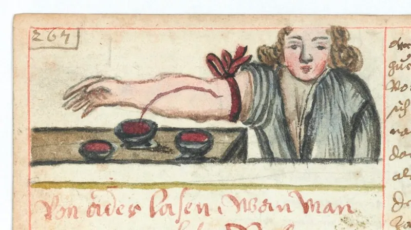 This 17th-century illustration shows bloodletting with bowls placed to collect blood. (Credit: Wellcome Collection)