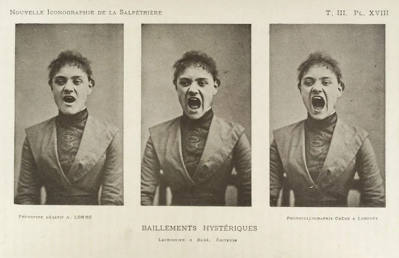 Hysterical yawning woman. Credit: Wellcome Collection.